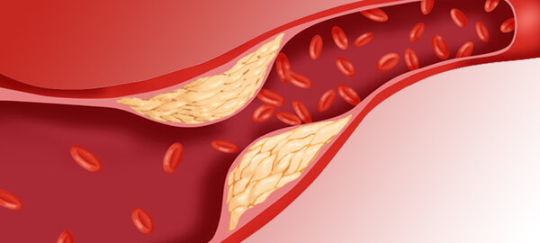 Очищение сосудов от бляшек: возможно ли это?