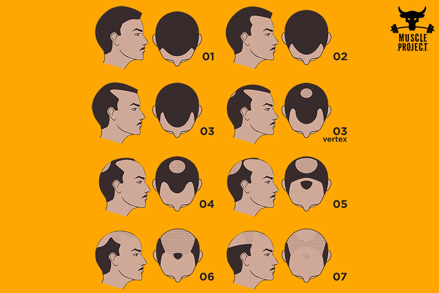 Виды облысения у мужчин