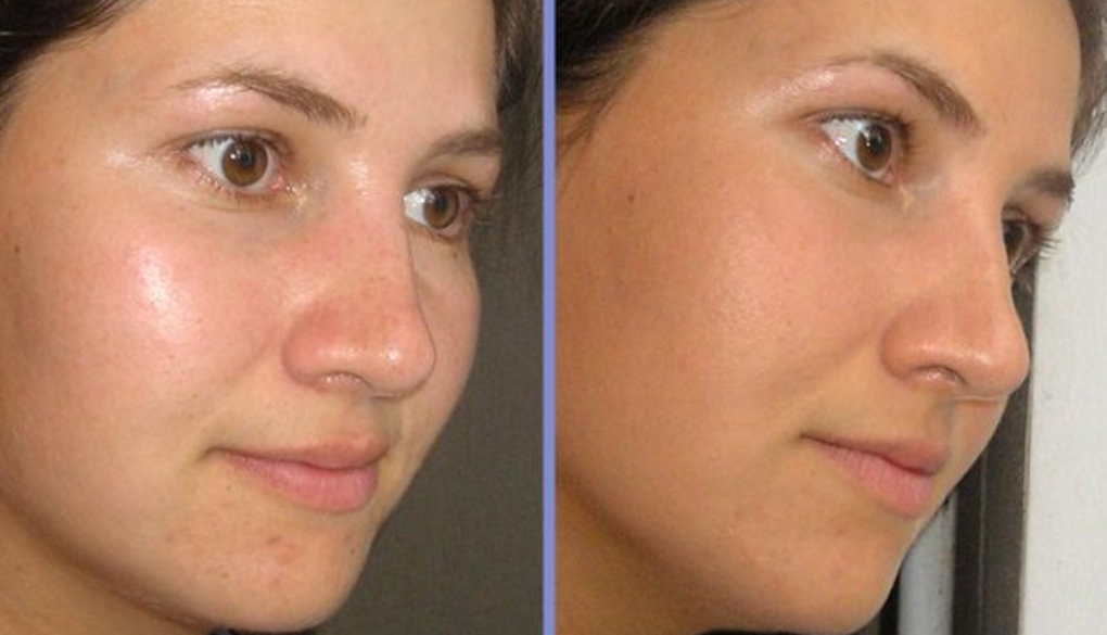 Три рецепта с использованием петрушки от пигментных пятен на лице Beauty Balance
