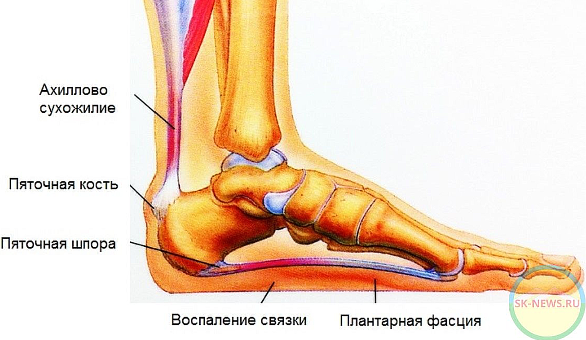 Подошвенный фасциит симптомы