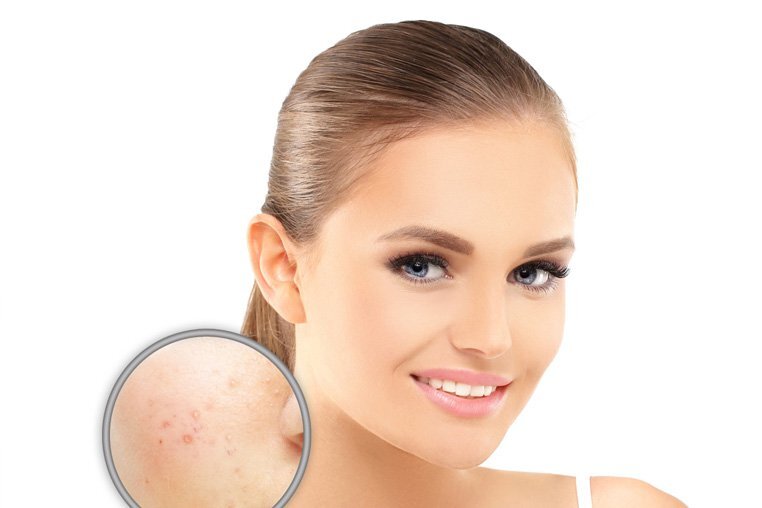 На ранних стадиях внешним проявлением розовых угрей является покраснение кожи лица, появление сосудистых сеточек и звездочек. Если не обратить внимание на эти тревожные симптомы и не принять меры, через несколько дней зона эритемы покрывается сыпью, которая  со временем трансформируется в гнойнички, локализующиеся, в основном, в Т-зоне. Затем появляются узлы и бляшки, площадь высыпаний увеличивается. Разрастается соединительная ткань, пораженные участки кожи уплотняются, становятся шершавыми и бугристыми. Нередки инфильтрация и отек кожи.