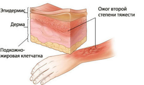  Повреждение эпидермиса с образованием волдырей