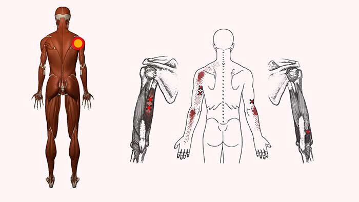 атлас триггерных точек. триггерные точки на теле человека. триггерные точки плечелучевой мышцы. клэр дэвис триггерные точки. карта триггерных точек.