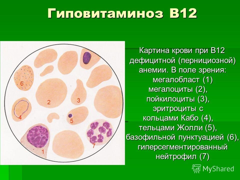 Картина крови при анемии