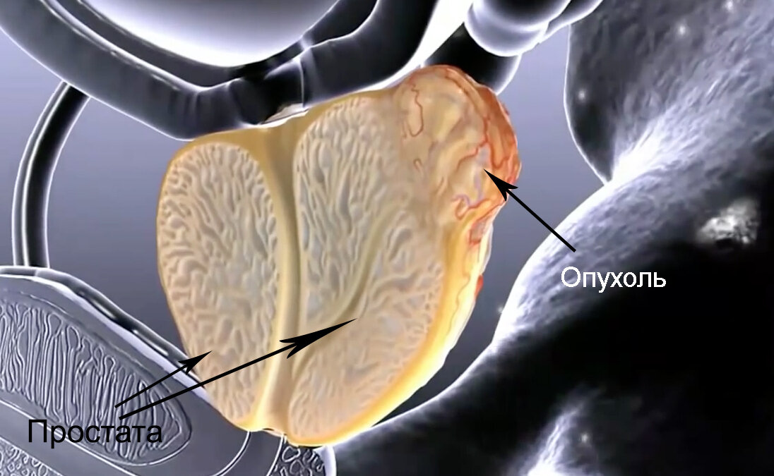 Опухоль простаты