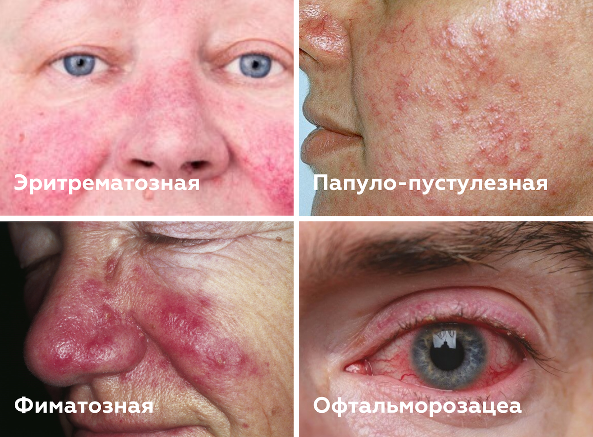 Красные щеки - Центр эстетической медицины ESTHETIQUE