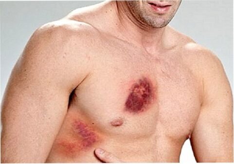  Травмы ребер и грудины