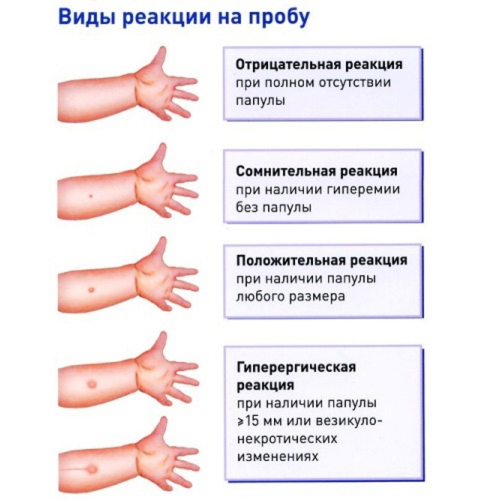 На какой день проверяют Манту у ребенка