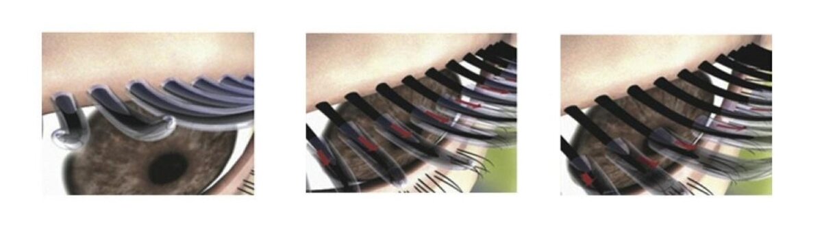 Так схематично выглядит удаление термостойкой туши