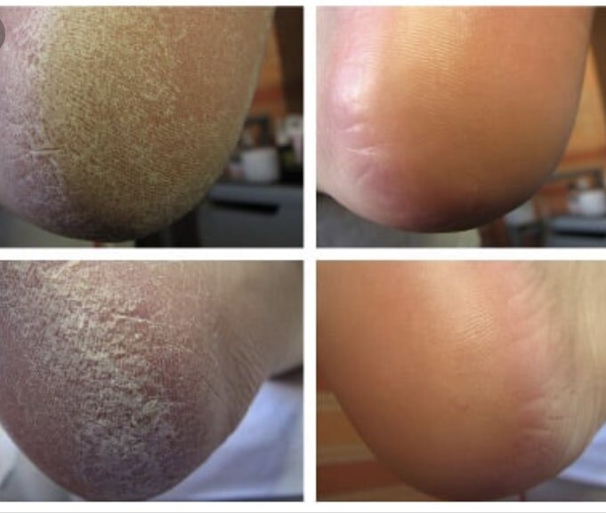 Пятка до и после обработки кислотой и пензой