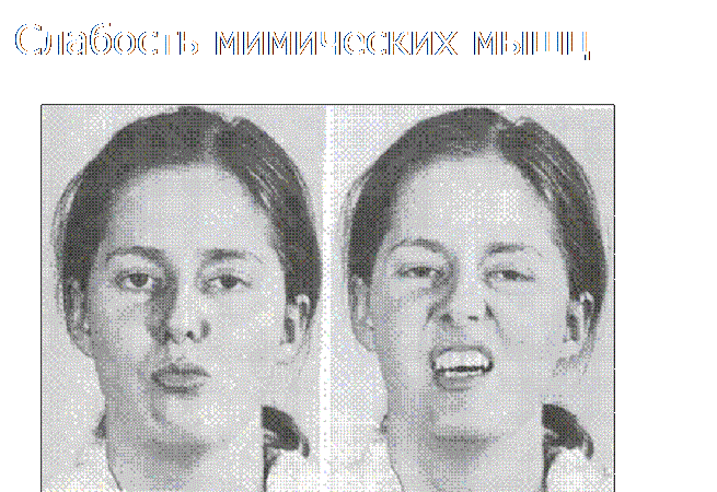 Данное аутосомно — рецессивное заболевание развивается у пациентов после 20 лет, а юношеская форма у детей и подростков 11—13-летнего возраста. Прогрессирование болезни происходит по восходящему варианту, то есть сначала поражаются мышцы нижних конечностей, и постепенно происходит восхождение недуга к верхним конечностям.