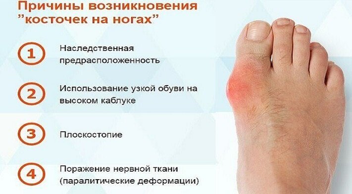 Виды вальгусной деформации большого пальца ноги