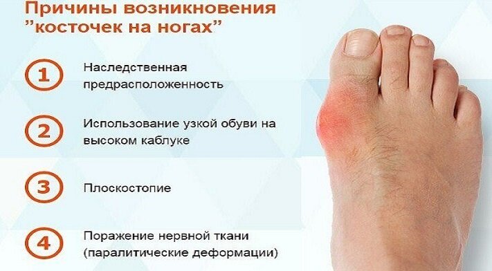 Вальгусная деформация 1 пальцев стоп (Hallux abducto valgus)