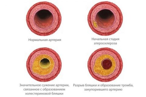 Холестерин – главный врач сосудов