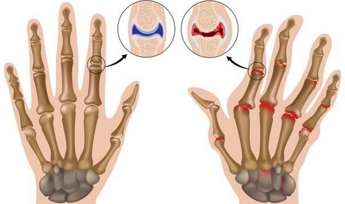 Ученые объяснили, почему пальцы хрустят