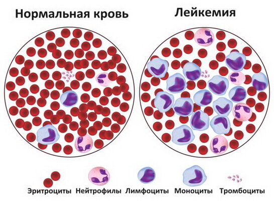 Лимфолейкоз хронический. Лечение хронического лимфолейкоза народными средствами