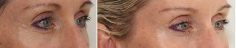 До и после, вакуумный скульптурный массаж