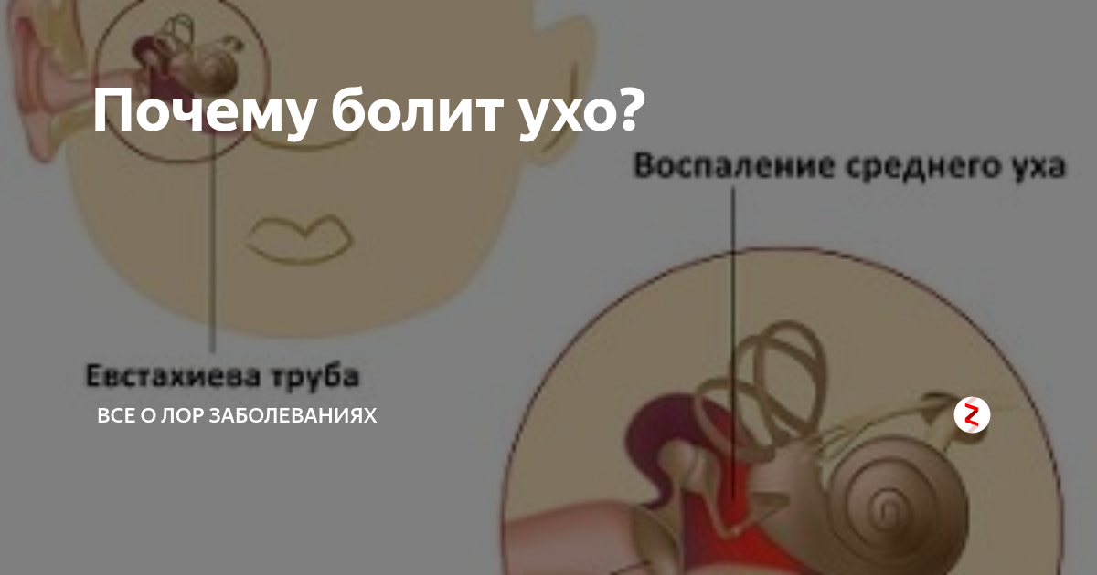 Как убрать заложенность уха дома. Болит внутри уха при нажатии.