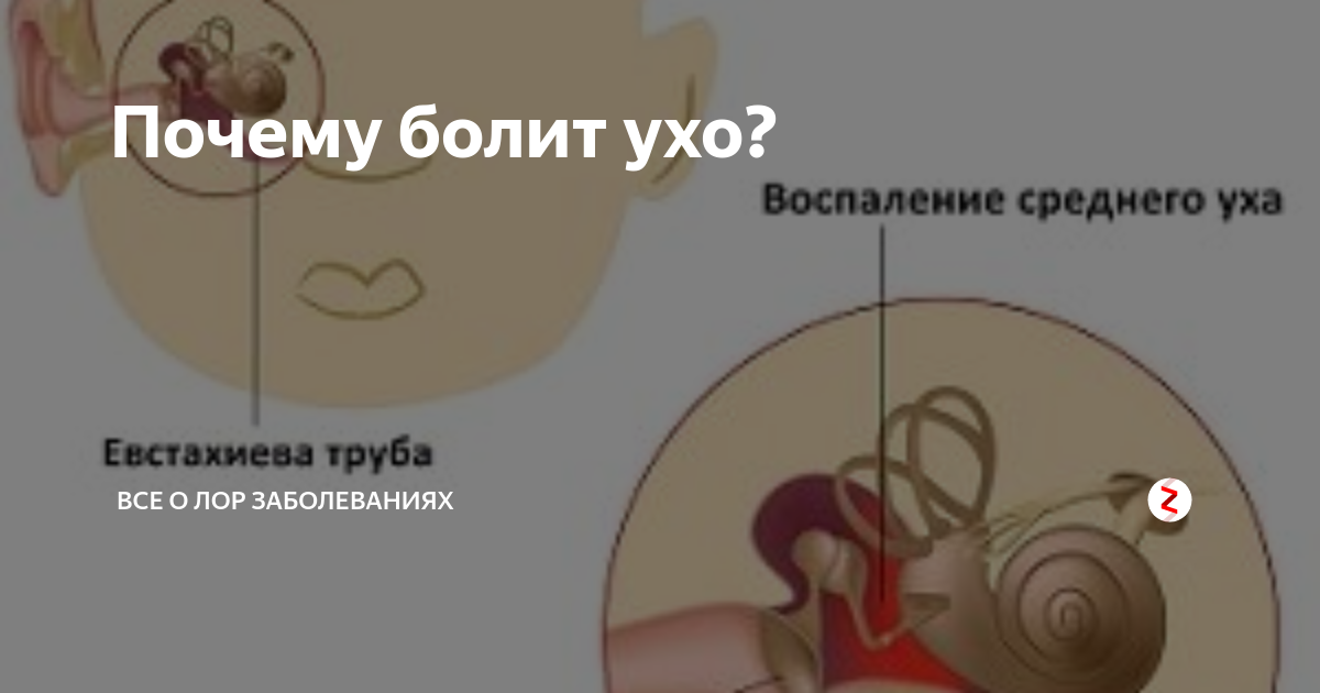 Почему может болеть ухо. Боли внутри уха причины. Болит глубоко внутри уха. Больно зевать в ухе болит.