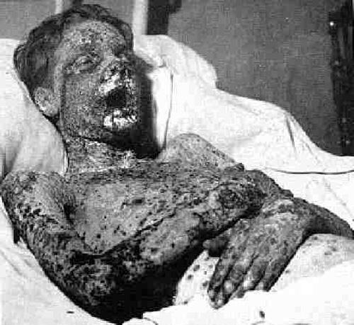 Даже в ХХ веке больные оспой сгнивали заживо