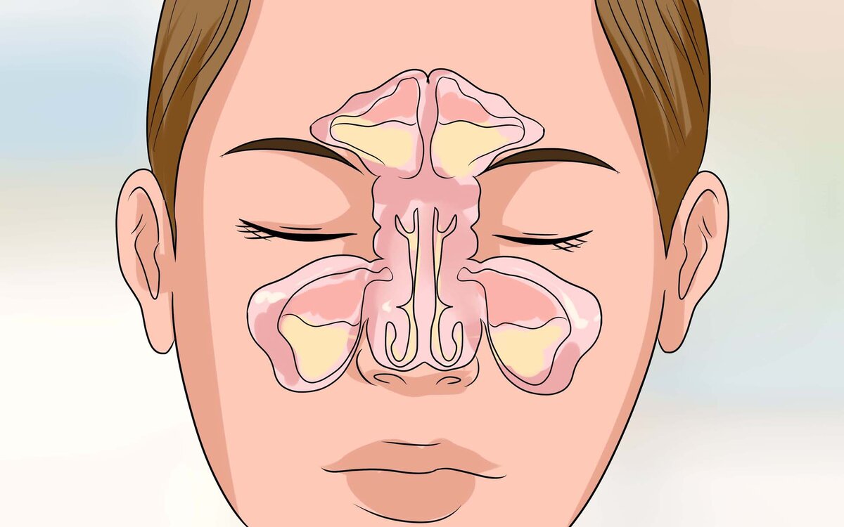 Можно ли в баню с гайморитом? Мифы и аргументы ЛОРов | Сауна.СПб.РУ | Дзен