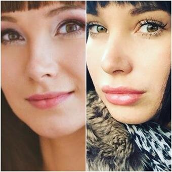 Купить Juvederm Smile (ювидерм смайл) в Москве - A