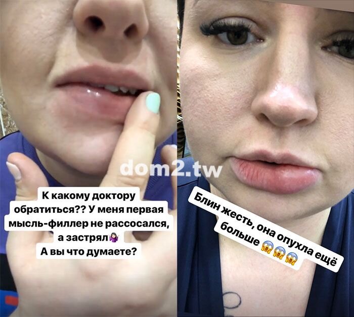 Александра Черно пожаловалась, что на её губе появилась опухоль