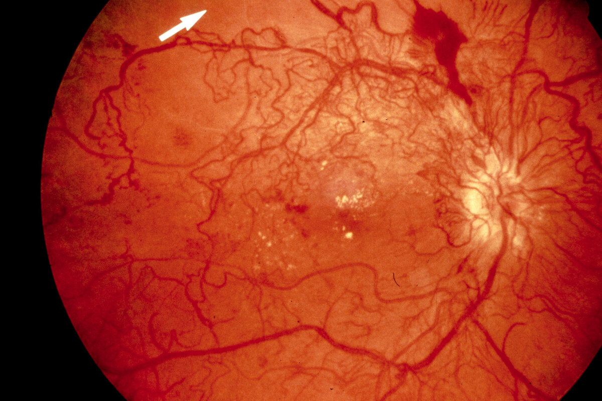 Изменение глазного дна при сахарном диабете презентация
