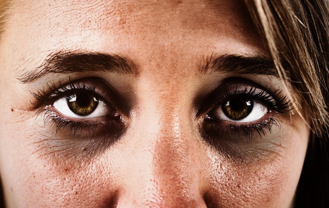 Темные круги под глазами - причины появления, симптомы заболевания, диагностика и способы лечения