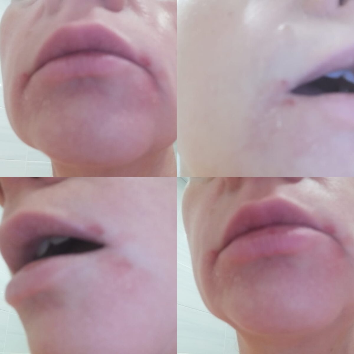 Раздражение кожи от ношения масок