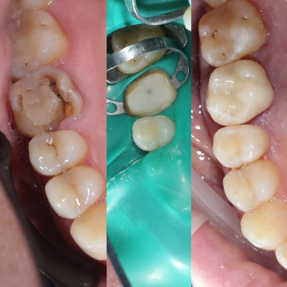 Зачем на запломбированный зуб ставить коронку? | Центр стоматологии ...