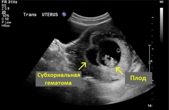 Гематома при беременности на ранних сроках