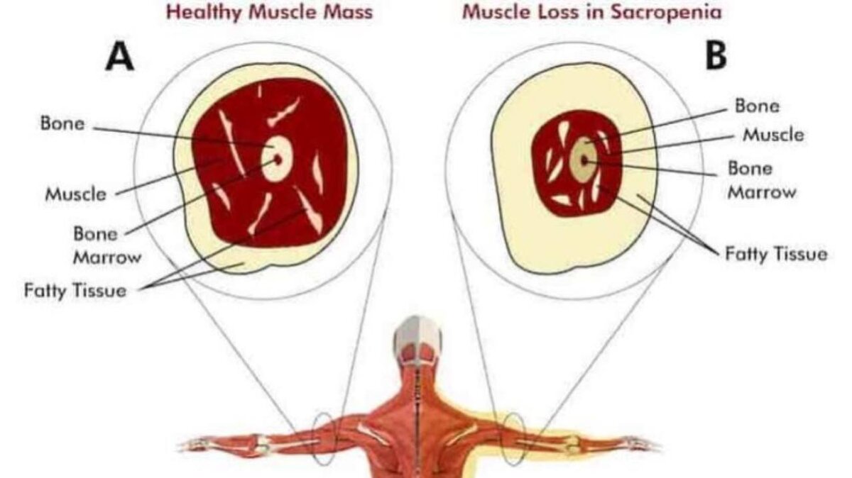 Вот так наглядно можно представить, как выглядит саркопеническое ожирение