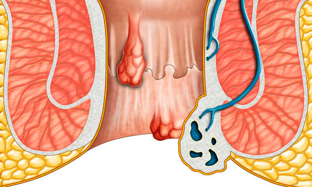Способы лечения геморроя