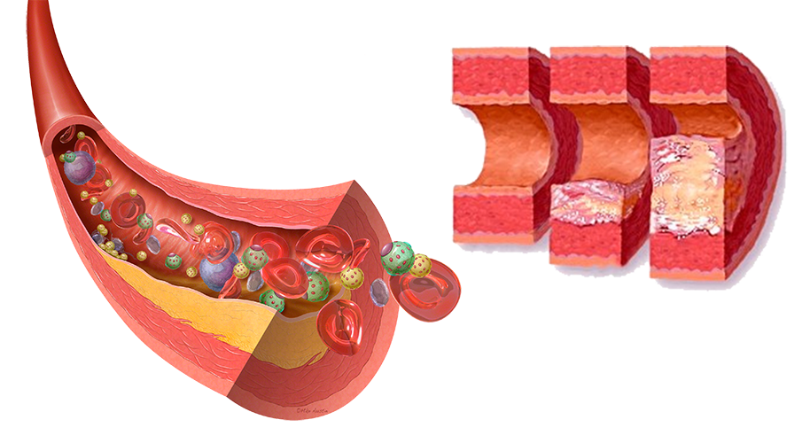 На фоне атеросклероза. Холестерин. Атеросклеротическая бляшка. Атеросклеротические бляшки в сосудах. Атеросклероз при сахарном диабете.