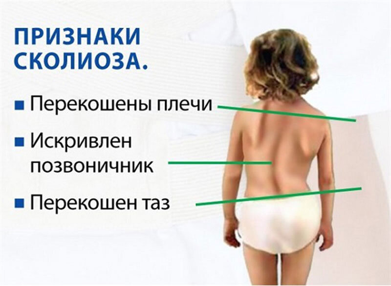 Искривление позвоночника скелет