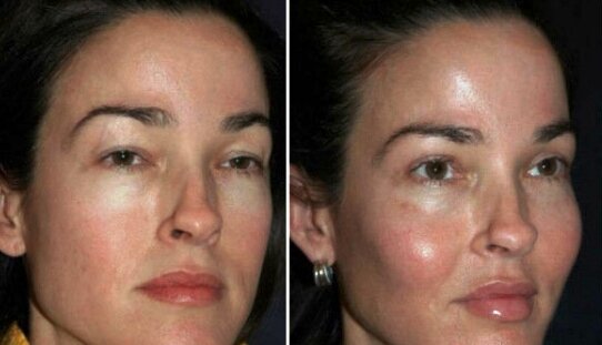 Скулы выделяются, но девушка уже не та - и лично мне нравится фото ДО