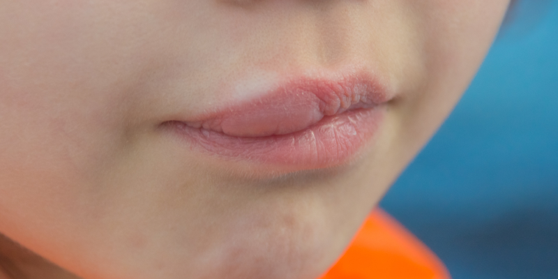 Чаще всего укус происходит в губы и руки, когда ребенок ест сладкое на прогулке и не замечает насекомое