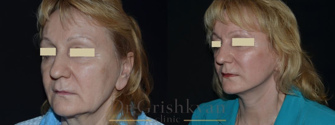 Фото до и после подтяжки лица. Фото с сайта Д.Р. Гришкяна. Имеются противопоказания, требуется консультация специалиста