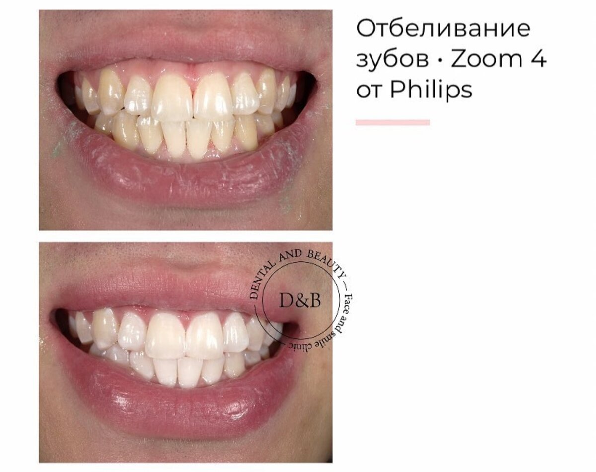 Пример отбеливания зубов 