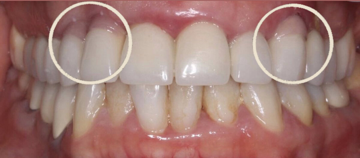 Одна из самых сложных работ за последнее время. | Стоматолог на всю ...