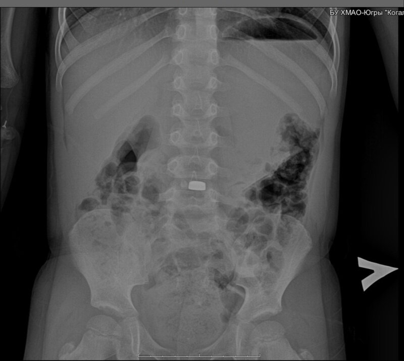    Когалымские врачи спасли малыша, который проглотил батарейку