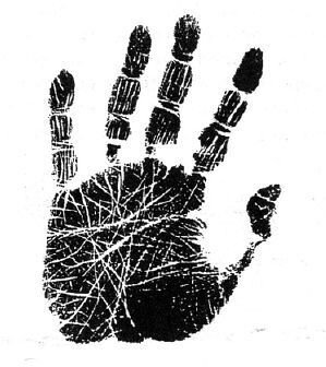 Белые линии (линии Бокариуса) на внутренней стороне ладони