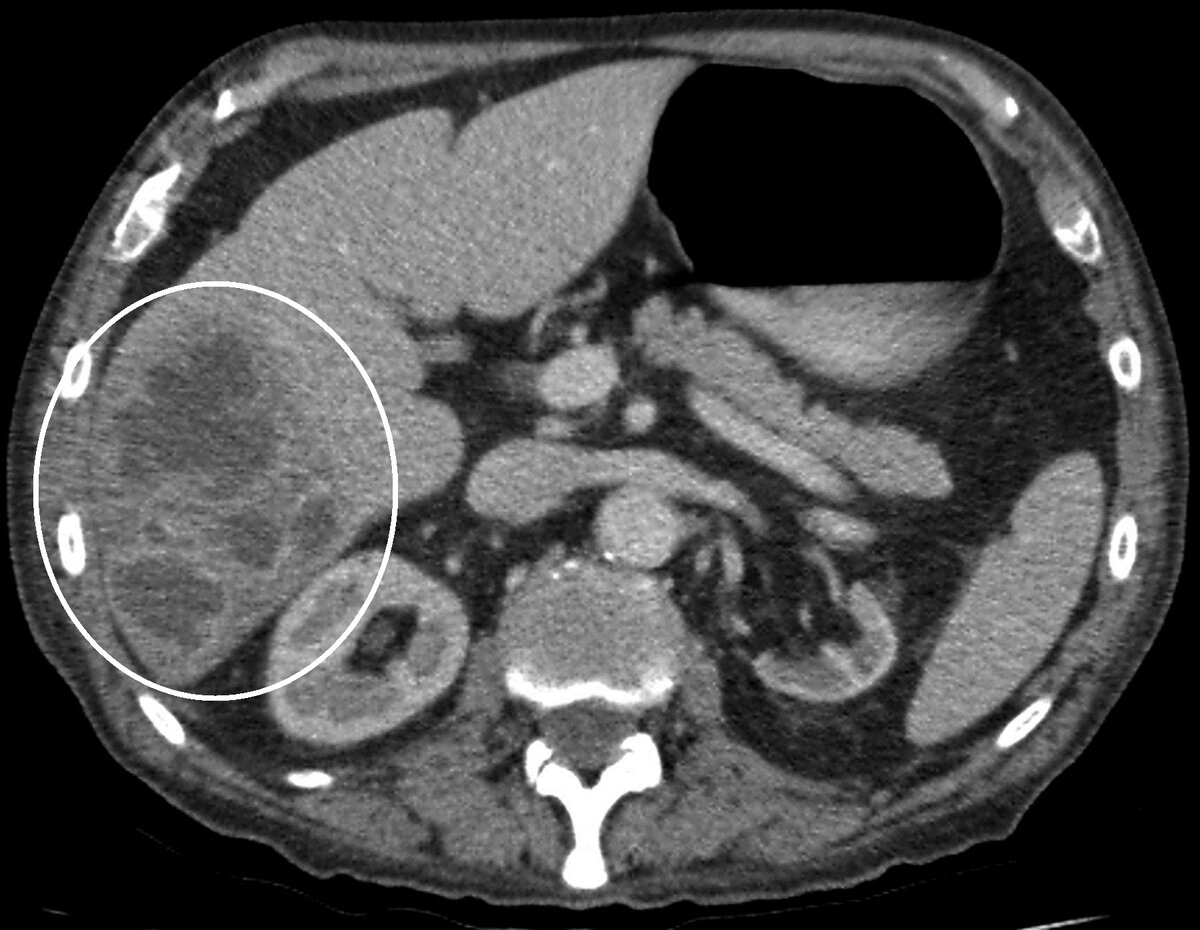 Абсцесс печени кт картина