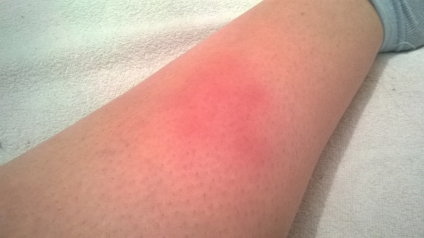 Пример отека на ноге ребенка