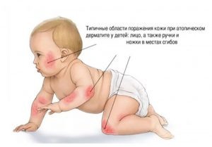 Очень важно правильно очищать кожу. Применение  обычных моющих и косметических средств,с рН> 7.0 , разрушает водно-жировую мантию кожи, может усилить сухую кожу, уменьшить толщину защитного рогового слоя, и служить фактором обострения АтД.