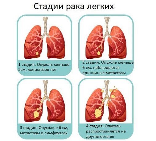 Лечение рака 4-й стадии в Израиле - Запись к врачу 24/7