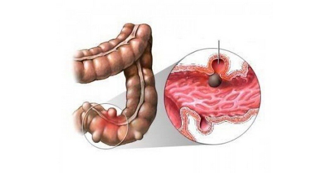 Sintomas de los diverticulos