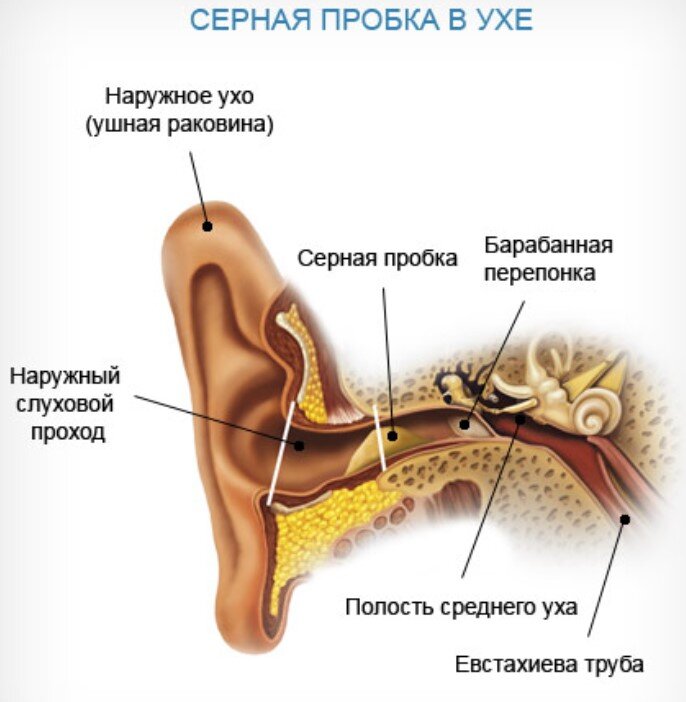 Виды ушных пробок. Симптомы образования серной пробки.