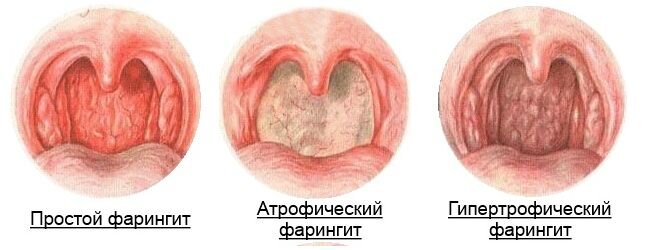 Фарингит – симптомы, диагностика и лечение в Major Clinic